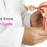 All You Need to Know About Ovarian Cysts